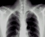 临床助理医师实践技能肺部疾病X线影像诊断图片试题