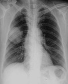 临床医师实践技能第三站考题：常见肺部疾病诊断