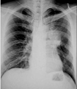 临床助理医师实践技能肺部疾病X线影像诊断图片试题