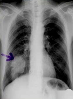 临床医师实践技能考题：X线平片影像诊断(呼吸系统疾病)