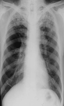 临床医师实践技能考题：X线平片影像诊断(呼吸系统疾病)